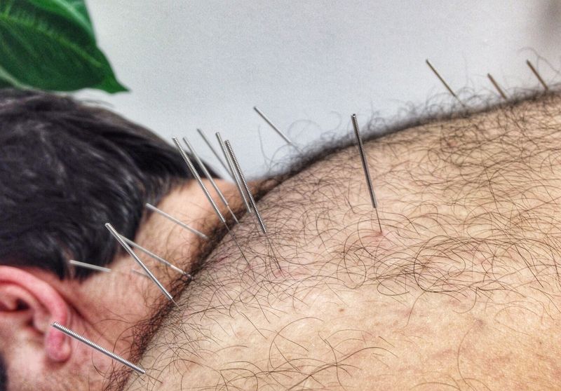 140823 Accupuncture